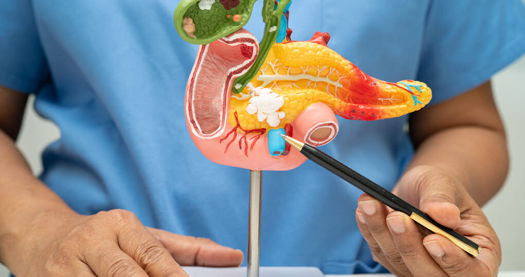 ¿Qué hacer si tienes quilomicronemia? Opciones en Guatemala