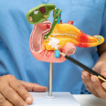 ¿Qué hacer si tienes quilomicronemia? Opciones en Guatemala