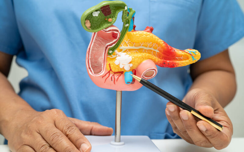 ¿Qué hacer si tienes quilomicronemia? Opciones en Guatemala